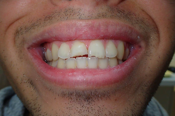 Dental Bonding before image