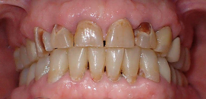 Dental crowns before image